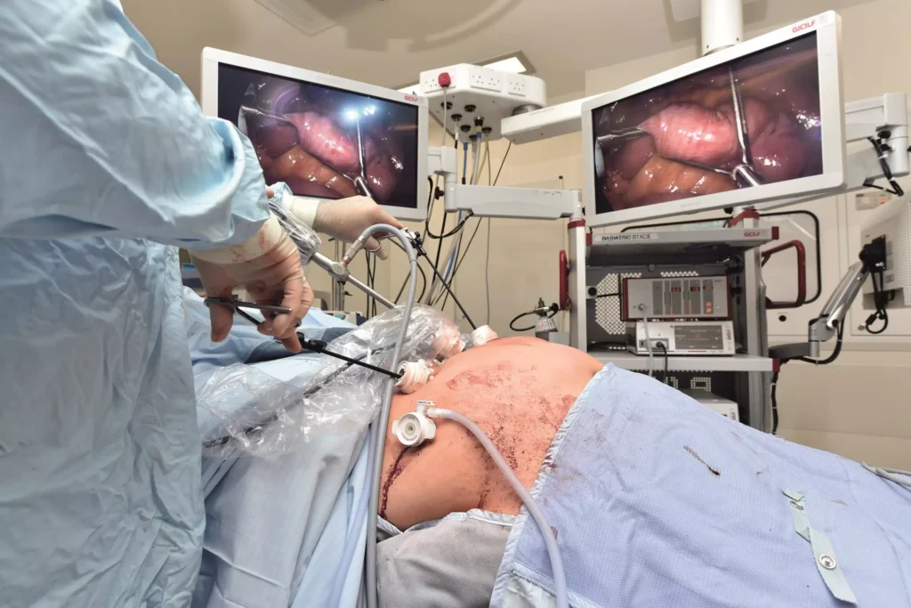bariatric-surgery-gastric-bypass-16-scaled-1.webp