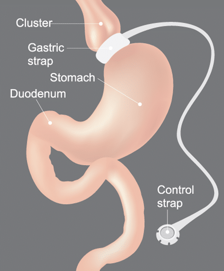 gastric